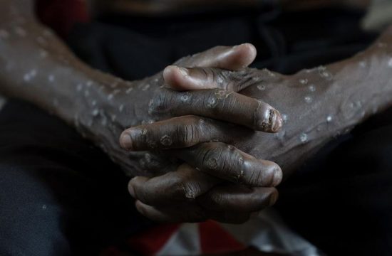 Munculnya Wabah Penyakit Baru di Beberapa Wilayah Afrika