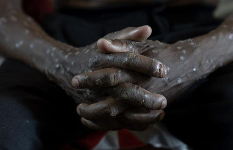 Munculnya Wabah Penyakit Baru di Beberapa Wilayah Afrika